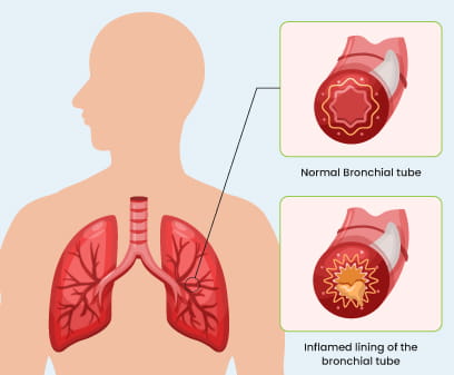 Bronchitis